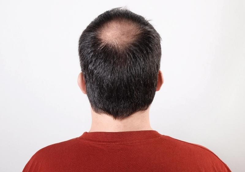 Read more about the article Alopecia e Calvície: Saiba tudo sobre essas condições