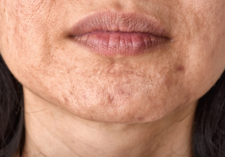 Read more about the article Cicatriz de acne e cravos: Causas, tratamentos e prevenção