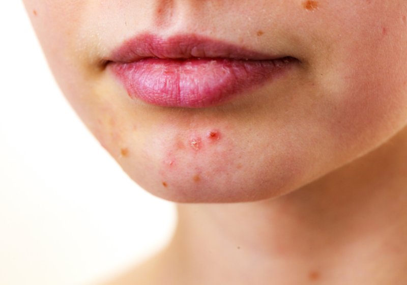 Read more about the article Como tratar acne e cravos: Saiba tudo aqui