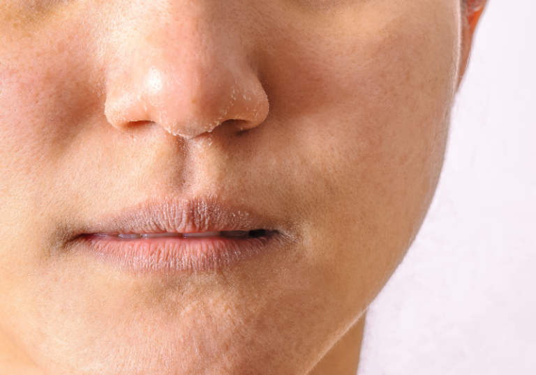 Read more about the article Pele descascando: Causas, como tratar e prevenir