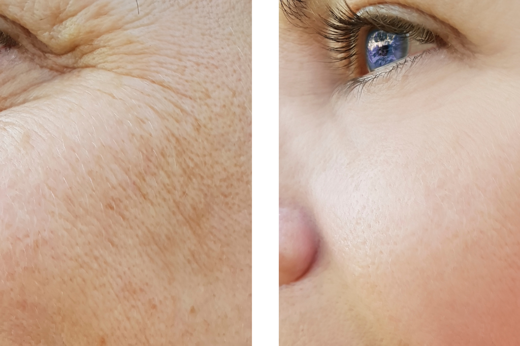 FK - Envelhecimento da pele