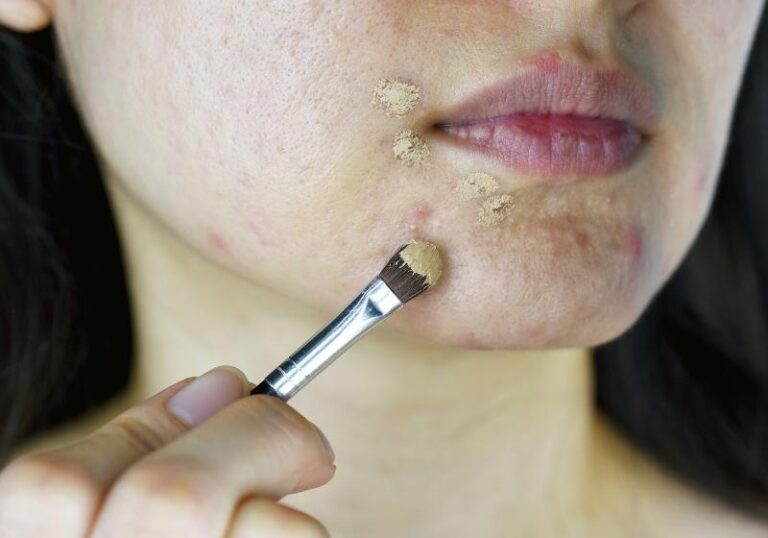 Read more about the article Esconder espinhas com maquiagem – Guia Completo